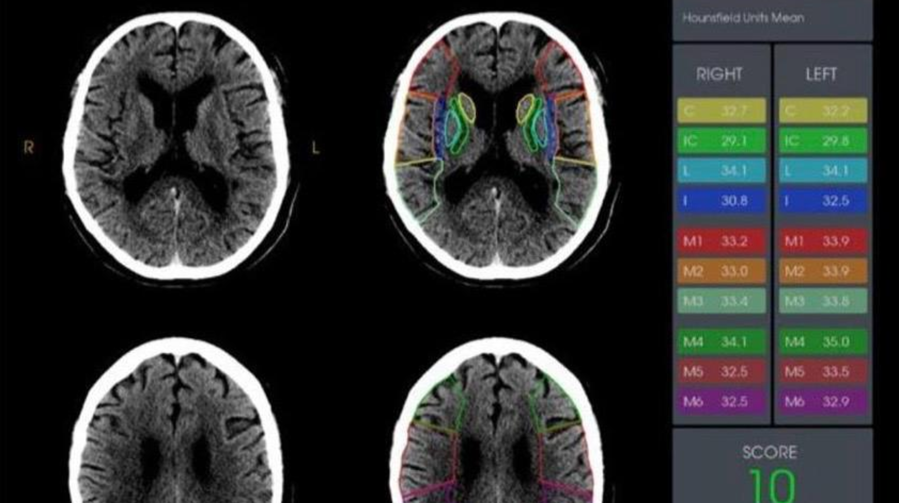 Jasandy ıntellekt almatylyq dárigerlerge adam ómirin qutqarýǵa kómektesti