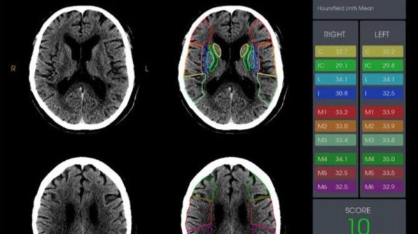 جاساندى ينتەللەكت الماتىلىق دارىگەرلەرگە ادام ءومىرىن قۇتقارۋعا كومەكتەستى