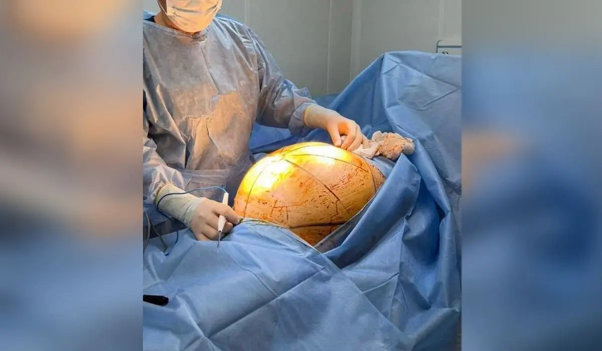 Алматыда дәрігерлер 25 келі алып ісігі бар науқастың өмірін сақтап қалды